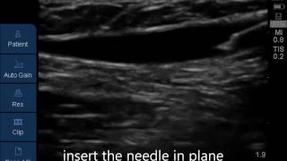 Peripheral Venus cannulation ultrasound guided [upl. by Yesoj]