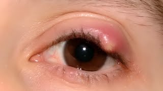 Chalazion Cyst [upl. by Aeslek]