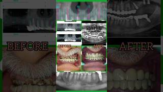 Screw Retained Fixed Ceramic DLMS CadCam Prosthesis  dentalimplantsnearme  Best Implant Center [upl. by Ellenet329]