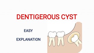 Dentigerous Cyst  Lecture  Odontogenic cysts  Oral Pathology  Easy explanation [upl. by Ettenajna808]