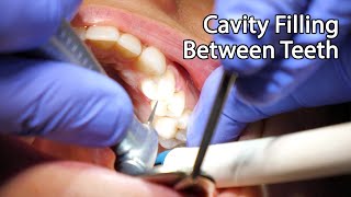 Dentist Filling A Cavity Between Teeth [upl. by Verdha964]