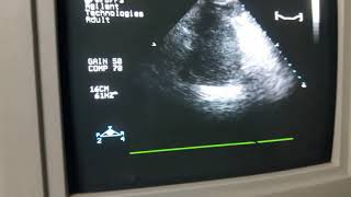 Unstable Angina and NSTEMI  A case prepared by Prof Saleh AlAwdhaly ‫‬ [upl. by Erida]