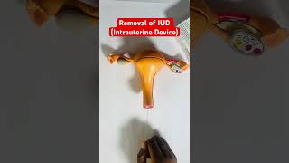 IUD Removal Demonstration [upl. by Imot]