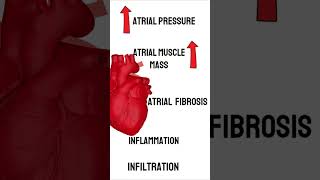 What causes Atrial Fibrillation medicine cardiology medical [upl. by Abigail]