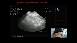 grande angiomiolipoma al rene destro [upl. by Bass]