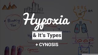 Hypoxia amp Cyanosis Causes amp PathogenesisTypes of Hypoxia Hypoxic  Anemic  Stagnant  Histotoxic [upl. by Noira]