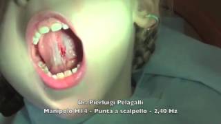 Frenulectomia Linguale con Laser FOTONA ErYAG  Dr Pierluigi Pelagalli [upl. by Neslund]