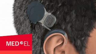 How Do Cochlear Implants Work The SYNCHRONY Cochlear Implant  MEDEL [upl. by Nowyt]