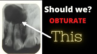 Should we Obturate tooth with periapical Radiolucency Dental ji [upl. by Dilks]