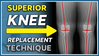 New game changing knee replacement technique explained  quotKinematicquot knee replacement [upl. by Anahsed]