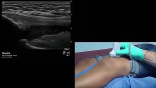 StepbyStep Ultrasound Guided IntraArticular Knee AspirationInjection Procedure [upl. by Ylim]