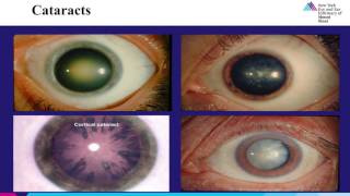 Elderly Eye Care Part 4 Cataracts [upl. by Tteraj360]