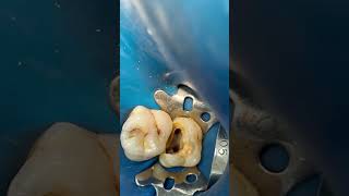 Molar 🦷 root canal treatment dentist dental dentalprocedure [upl. by Romeyn]