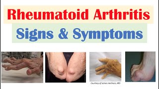 Rheumatoid Arthritis RA Signs amp Symptoms amp Associated Complications [upl. by Rufina]