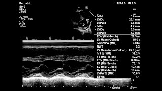 Basic echocardiography심장 초음파 기본 Parasternal short axis에서 M mode 측정 [upl. by Dracir]