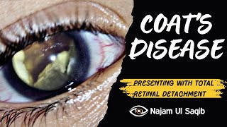 Coats Disease Presenting With Exudative Retinal Detachment [upl. by Aicilf176]