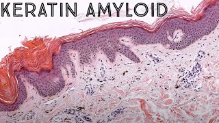 Keratin Amyloid Lichen amyloid vs Macular amyloidosis NOT systemic amyloidosis pathology [upl. by Dorice]