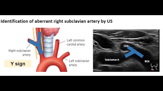 ENGAberrant right subclavian artery [upl. by Osy]