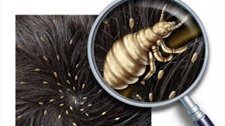 How to Get Rid of Head Lice Fast  Home Remedies For Lice [upl. by Eiramaliehs]