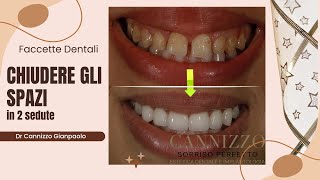 Estetica dentale con faccette in ceramica  Studio Cannizzo [upl. by Katheryn]