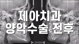 제아치과 양악수술 전후  zeah dental cephalometry superimposition before and after two jaw surgery [upl. by Mitinger]