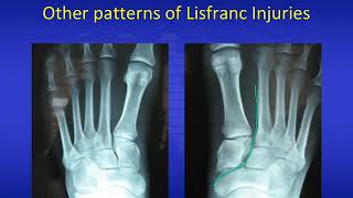 Lisfranc injuries 2020 [upl. by Nelleoj243]