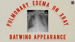 PULMONARY EDEMA vs SARCOIDOSIS  THE BATWING APPEARANCE HOW TO IDENTIFY [upl. by Aihsenek]