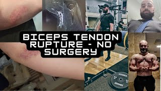 Biceps rupture  Nonsurgical rehab [upl. by Farny]