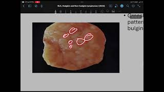 Pathology Hodgkin and NonHodgkin lymphomas part 2 [upl. by Ytinirt]