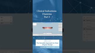 Clinical Indications Diastema Part 5 [upl. by Ozen600]