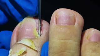 Yellow Toenail Nightmare vs Ingrown Toenail Removal [upl. by Euqinomad]