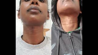 transgender trachea shave adhesion release Dr keojampa left Dr jumaily right [upl. by Anirbus297]