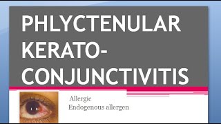 Ophthalmology PHLYCTENULAR KERATOCONJUNCTIVITIS KERATITIS TB Miliary Sacrofulous Fascicular Salzmann [upl. by Mcquoid481]