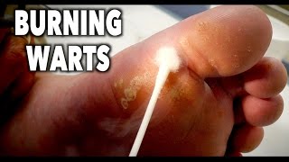 BURNING OFF a HUGE FAMILY of WARTS with liquid nitrogen  Dr Paul [upl. by Leshia]