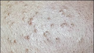 Squeezing blackheads for Khoa P1 HoangMySpa85 [upl. by Jeritah727]