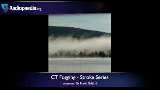 Stroke Fogging phenomenon on CT  radiology video tutorial [upl. by Annahpos204]