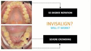 Dr Ibrahim Invisalign Case Review Rotations With AcceleDent [upl. by Bengt]