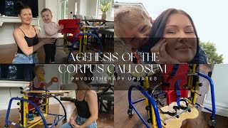 Agenesis of the Corpus Callosum  Physiotherapy Updates [upl. by Eelegna]