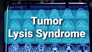 Tumor Lysis Syndrome [upl. by Maegan]