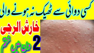 Kharash الرجی ka ilaj alarji خارش ka fori ilaj itching skin alarji ilaj [upl. by Einnos]