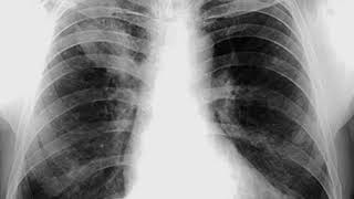 Case 0107 Bronchogenic Carcinoma right upper lobe with metastasis [upl. by Hagan]