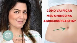 Clube da Plástica Como vai ficar meu umbigo na abdominoplastia [upl. by Ykroc]