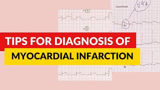 Tips for diagnosis of myocardial infarction ECGEKG interpretation [upl. by Anrol]