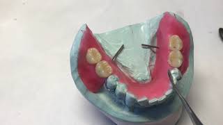 Laboratory procedures for fabrication of an acrylic based removable partial denture [upl. by Namlaz]