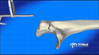 Olecranon Hook Plate Animated Demo [upl. by Lecrad]