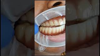 Anterior Deprogrammer tosafeguard the full arch implants and teeth fitting video shorts [upl. by Arayk]