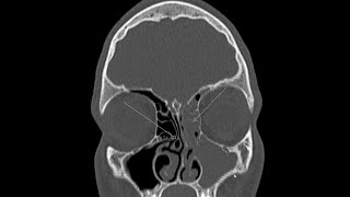 Potts Puffy tumour  understanding the pathogenesis [upl. by Ardehs743]