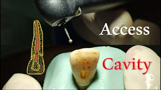 Access Cavity Preparation  Central Incisor [upl. by Anaiuq]