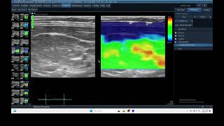 IQ 284 LIVER ELASTOGRAPHY GI BLEEDING ULTRASOUND ECHOPAC ANALYSIS [upl. by Sayre]