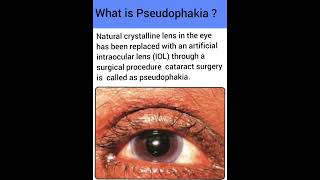 What is Pseudophakia  Optometry Fans [upl. by Acinemod359]